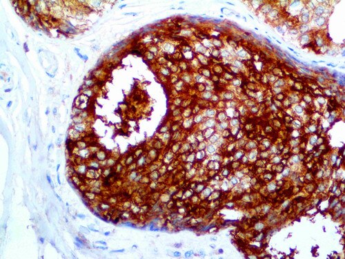 IHC of GCDFP-15 RMab on an FFPE Breast Carcinoma Tissue